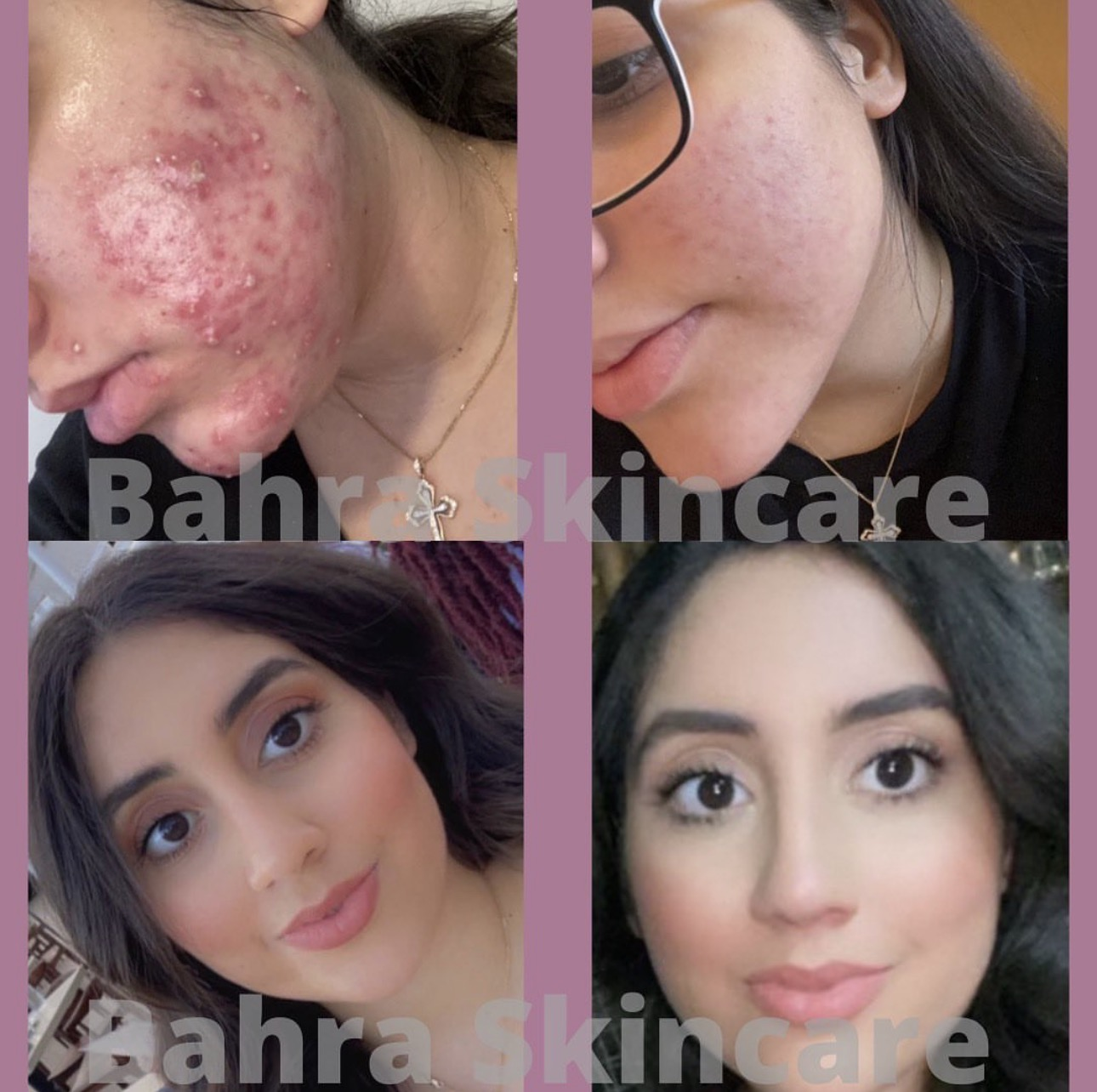 Before and after acne clearing skin transformation