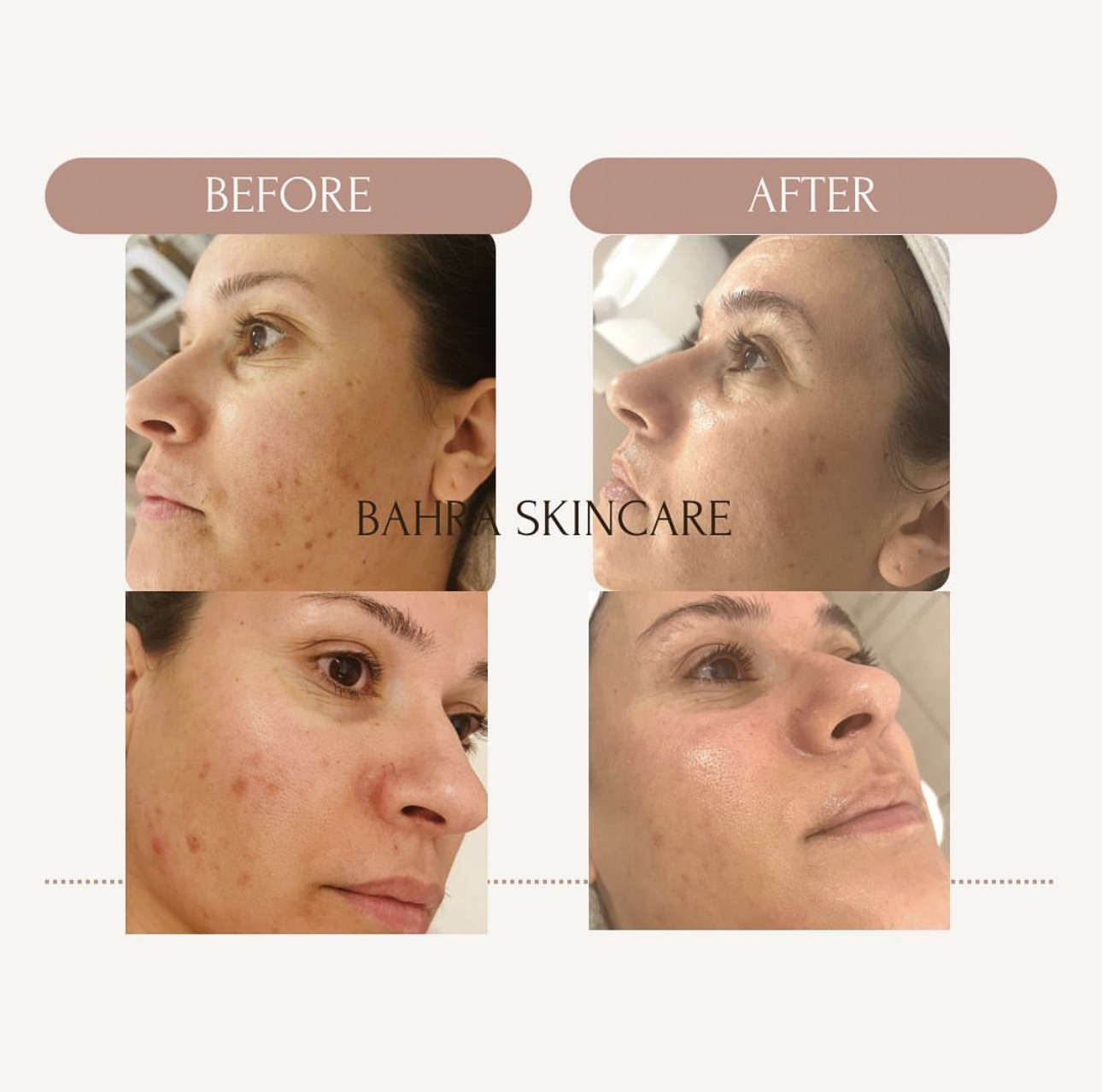 Before and after skin tone and texture renewal treatment at Bahra Skincare