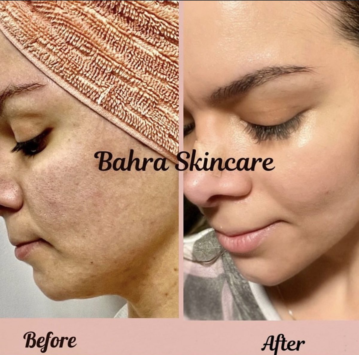 Before and after facial treatment at Bahra Skincare showing smoother texture and a radiant glow