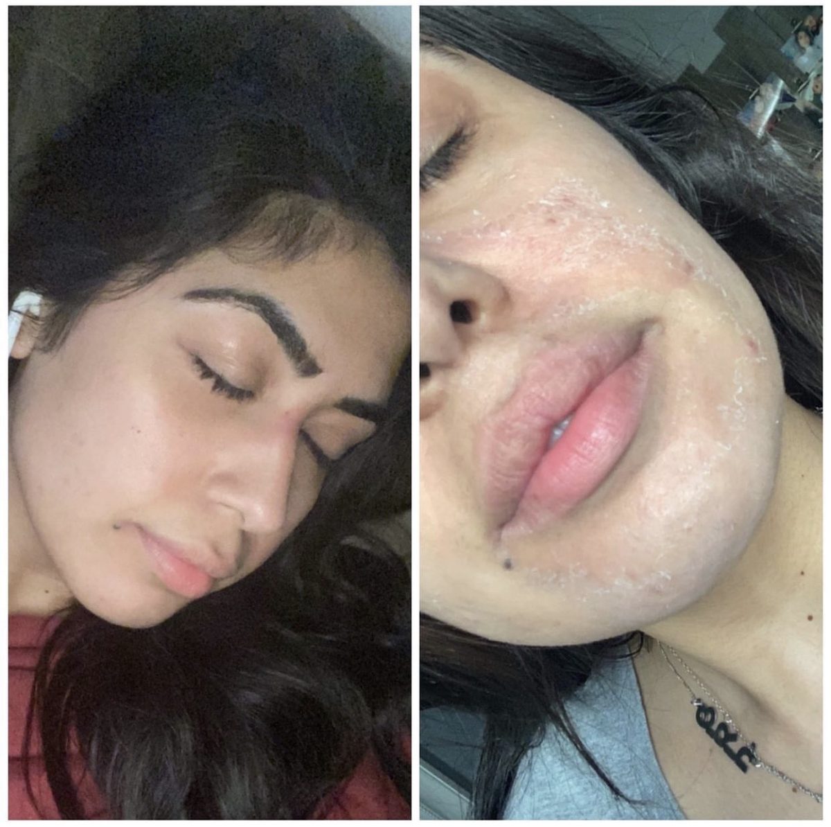 Before and after showing visible skin renewal during a chemical exfoliation journey