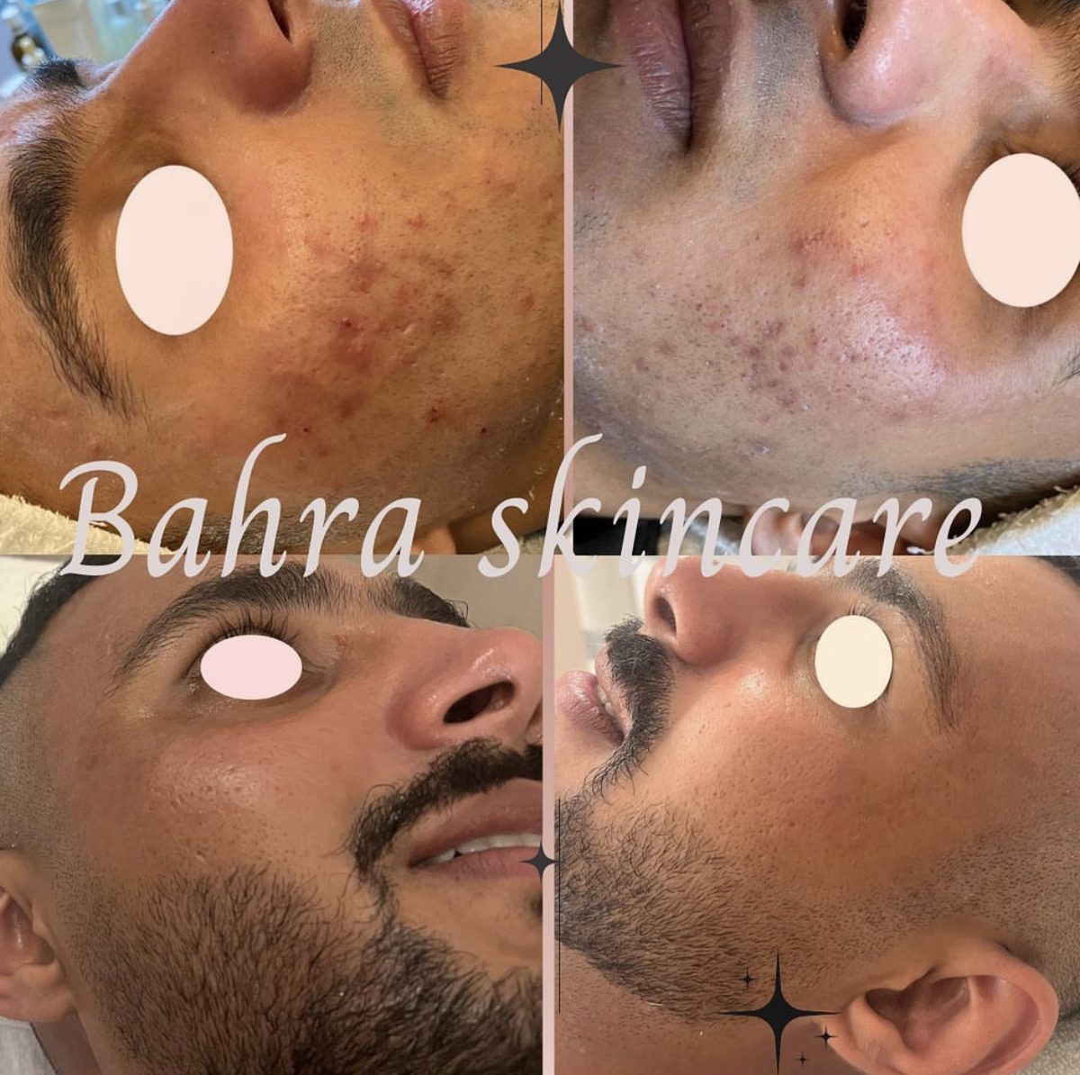 Before and after acne treatment results for a male client at Bahra Skincare